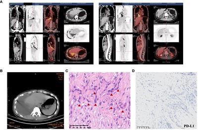 Non-bacterial cystitis caused by pembrolizumab therapy for adenocarcinoma of the lung: a case report